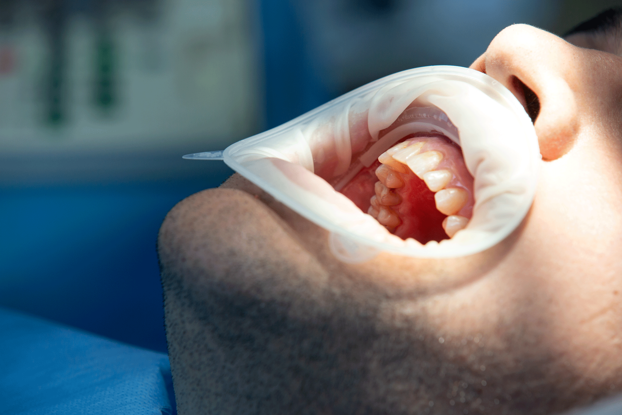 Chirurgie des dents de sagesse