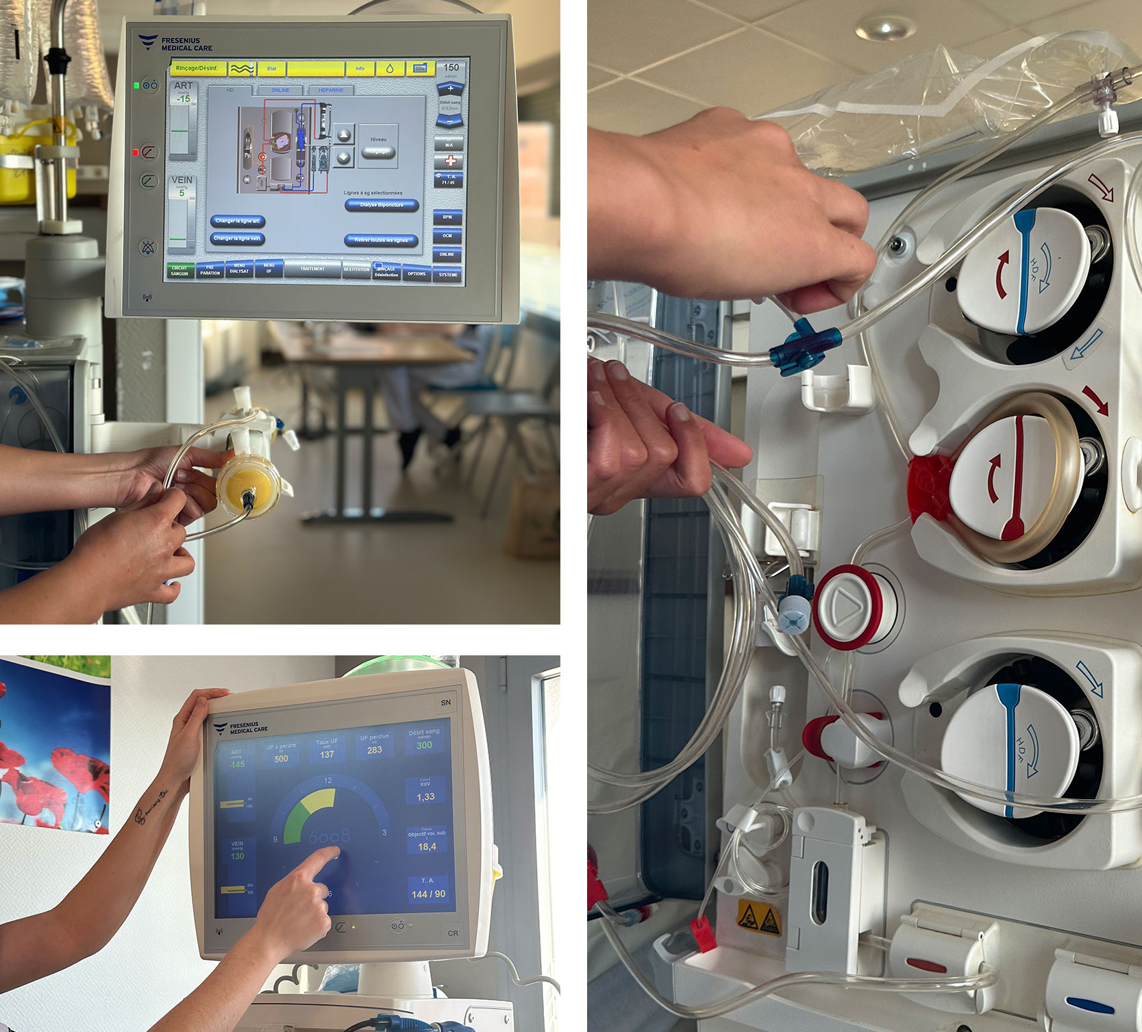 Insuffisance rénale aiguë et chronique