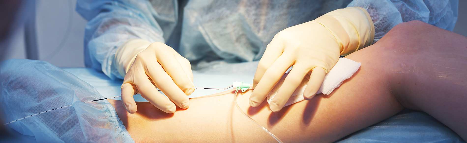 Chirurgie des varices