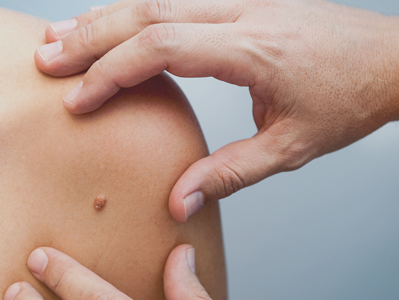 MALADIES DE LA PEAU ET DU CUIR CHEVELU