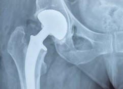 Chirurgie de la hanche